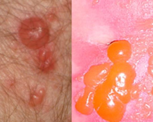 Figure 2. Skin Reaction to Wild Parsnip Sap